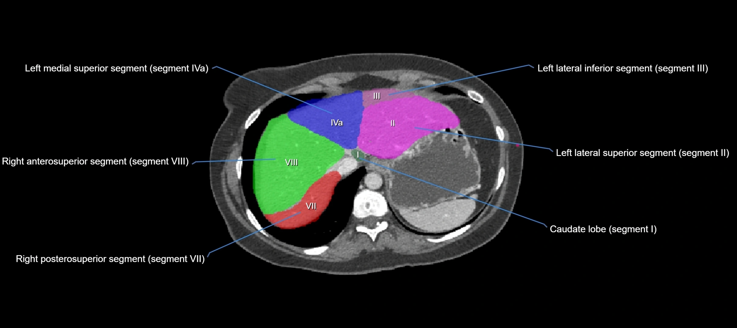 CT liver segments axial cross sectional anatomy labelled image-00065.webp